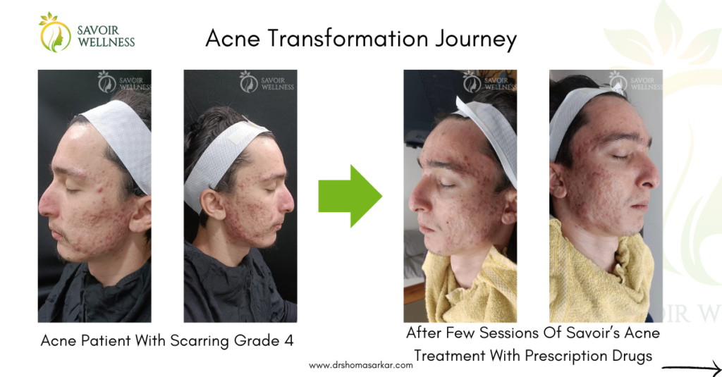 Embracing Transformation: A Journey to Clearer Skin with Savoir Wellness