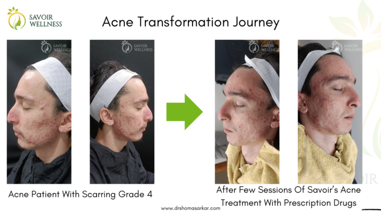 Embracing Transformation: A Journey to Clearer Skin with Savoir Wellness