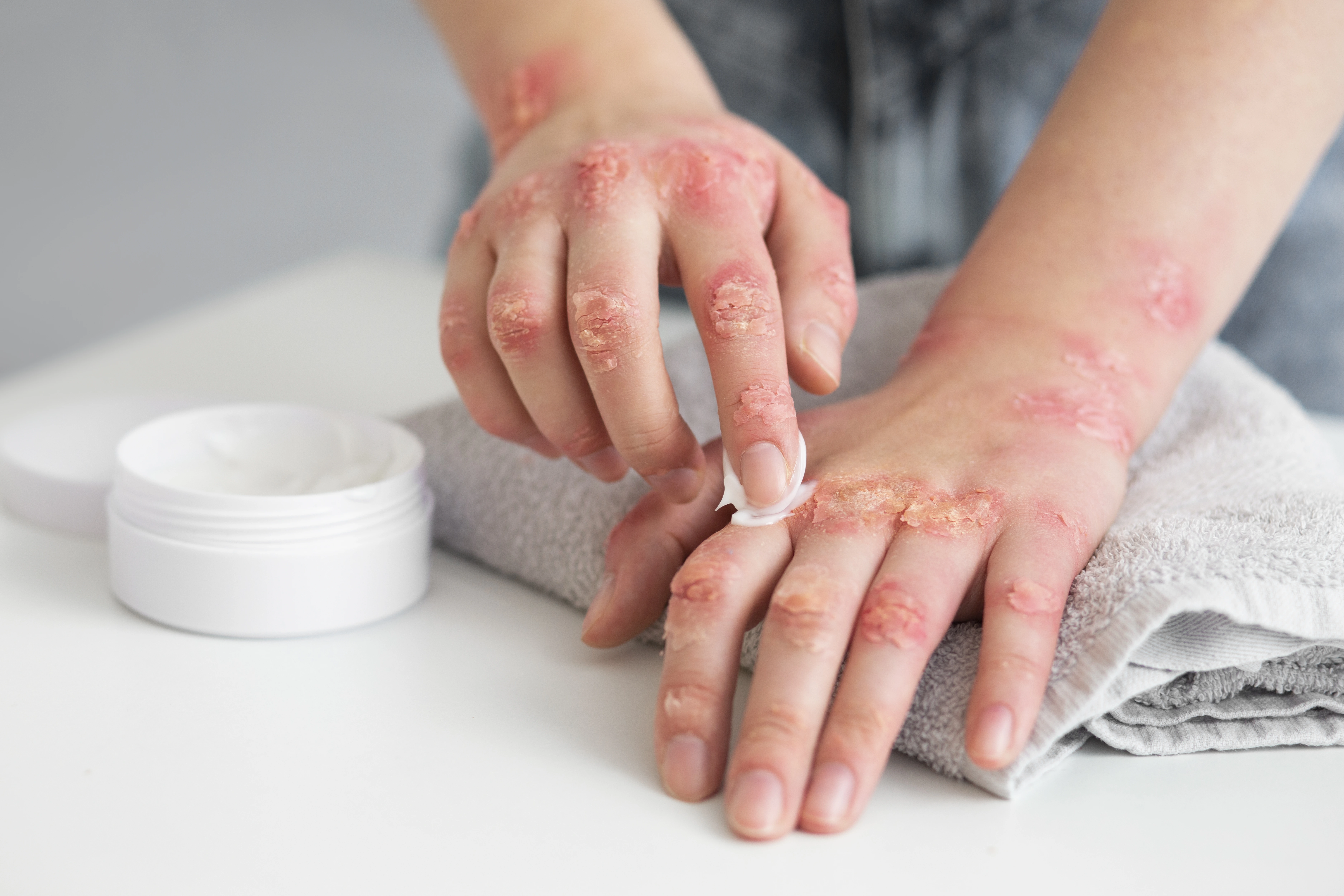 Atopic Dermatitis Explained