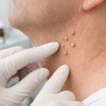 Skin Tags Removal