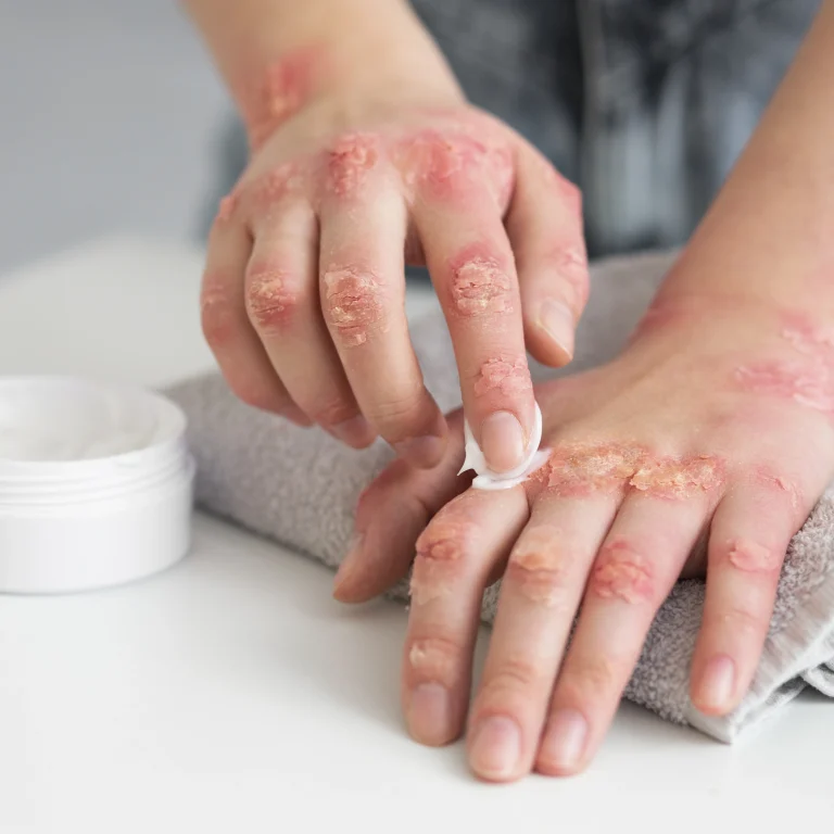 Atopic Dermatitis Explained
